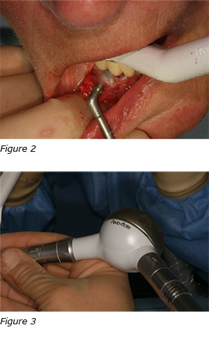 Figure 2 and 3